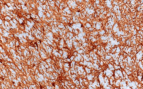 5C1 Central neurocytoma, atypical (Case 5) GFAP 40X