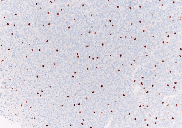 5C3 Central neurocytoma, atypical (Copy 5) Olig2 20X