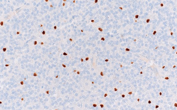 5C4 Central neurocytoma, atypical (Case 5) Olig2 40X