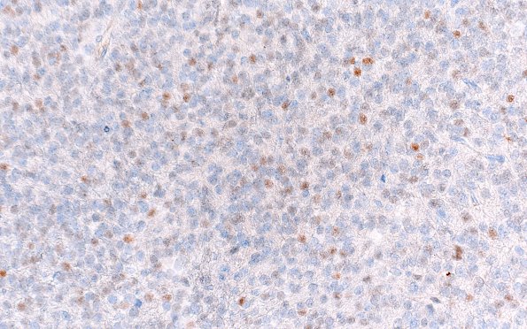 5D3 Central neurocytoma, atypical (Case 5) p53 40X