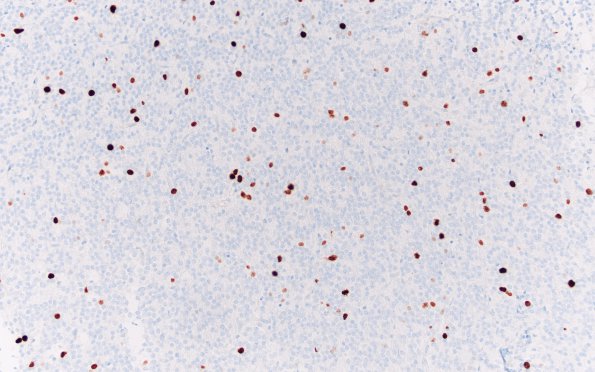 5E1 Central neurocytoma, atypical (Case 5) Ki67 20X