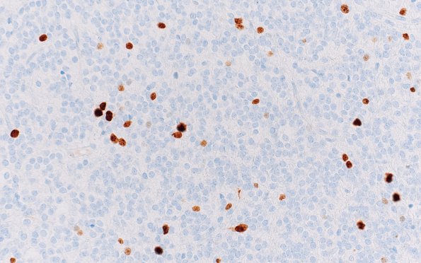 5E2 Central neurocytoma, atypical (Case 5) Ki67 40X