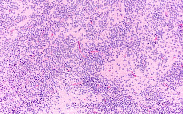 6A1 Central Neurocytoma (Case 6) H&E 20X 2