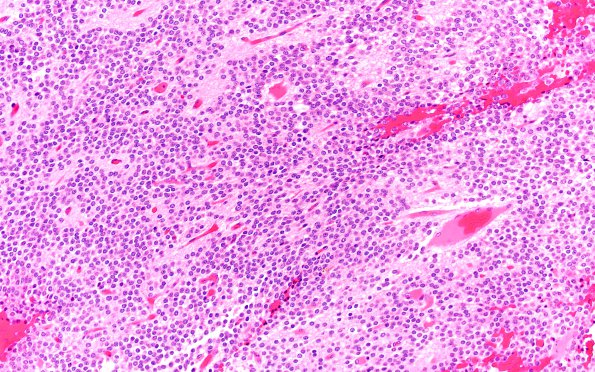 6A2 Central Neurocytoma (Case 6) H&E 20X