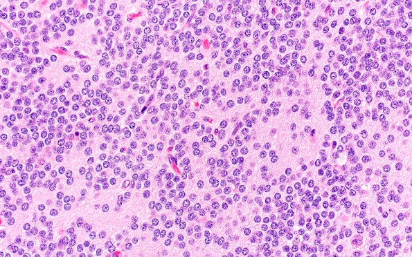 6A3 Central Neurocytoma (Case 6) H&E 40X