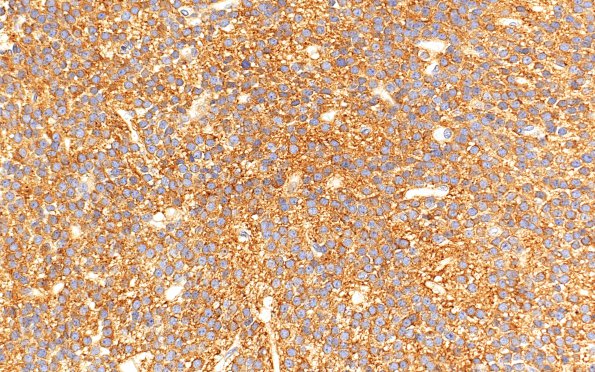 6B1 Central Neurocytoma (Case 6) SYN 40X