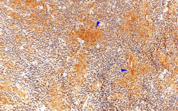 6B2 Central Neurocytoma (Case 6) SYN 20X copy