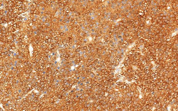 6B3 Central Neurocytoma (Case 6) NSE 40X