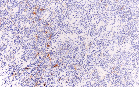 6C Central Neurocytoma (Case 6) GFAP 20X