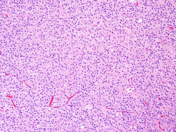 7A1 Neurocytoma, central, atypical (Case 7) H&E 10.jpg