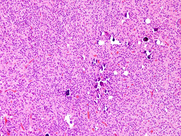 7A2 Neurocytoma, central, atypical (Case 7) H&E 1.jpg