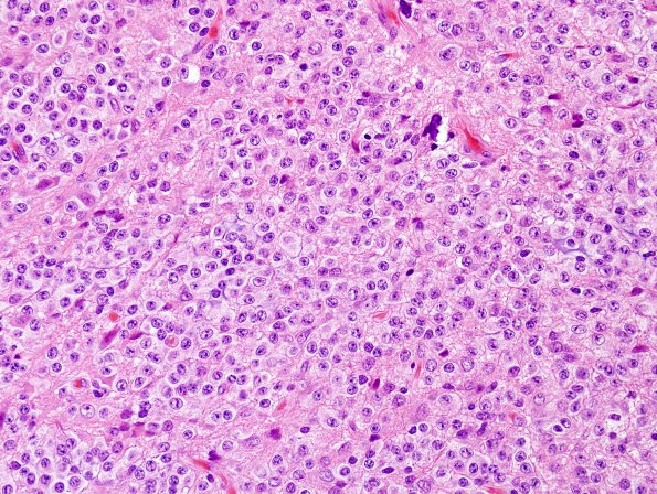 7A3 Neurocytoma, central, atypical (Case 7) H&E 6.jpg