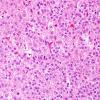 7A4 Neurocytoma, central, atypical (Case 7) H&E 12.jpg