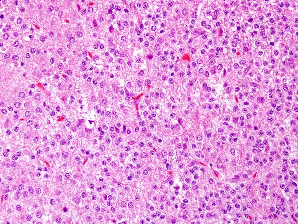 7A4 Neurocytoma, central, atypical (Case 7) H&E 12.jpg