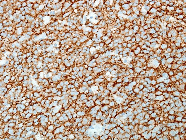 7B1 Neurocytoma, central, atypical (Case 7) SYN 3.jpg