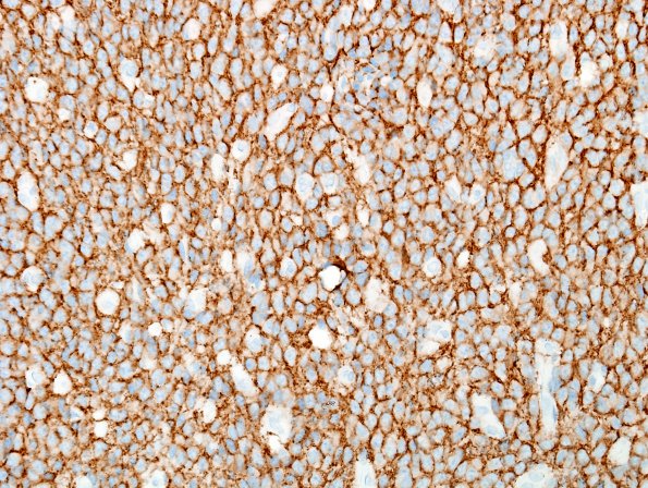 7B2 Neurocytoma, central, atypical (Case 7) SYN 4.jpg