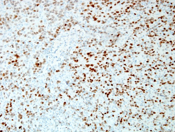 7C1 Neurocytoma, central, atypical (Case 7) NeuN 3.jpg