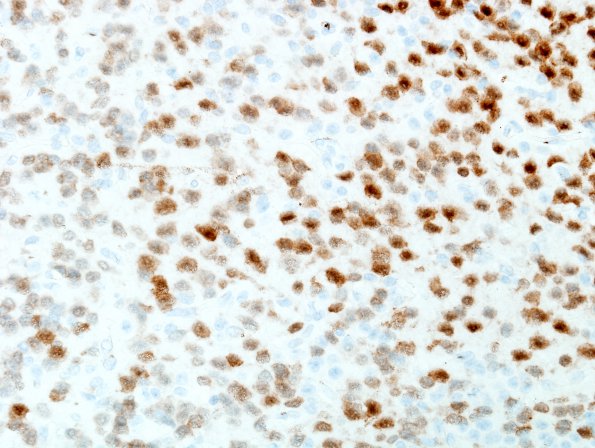 7C2 Neurocytoma, central, atypical (Case 7) NeuN 2.jpg