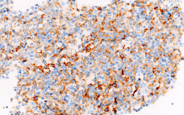 7E Neurocytoma, central, atypical (Case 7) Chromogranin