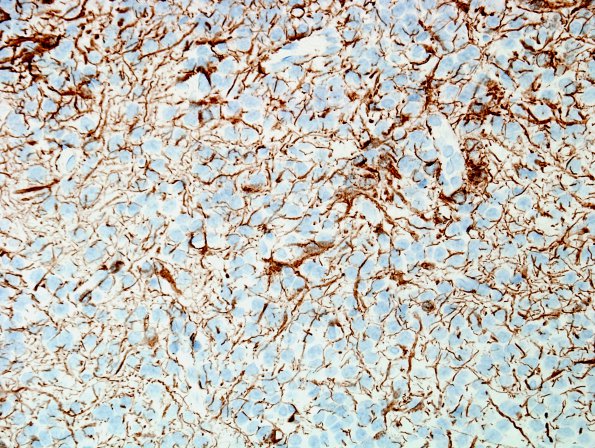 7F1 Neurocytoma, central, atypical (Case 7) GFAP2.jpg