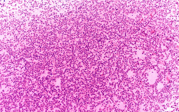 8A1 Neurocytoma, central (Case 8) H&E 20X