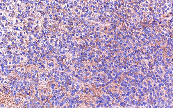 8B Neurocytoma, central (Case 8) SYN 40X