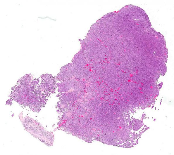 9A1 Neurocytoma, central (AANP 1999, Case 3) H&E X1