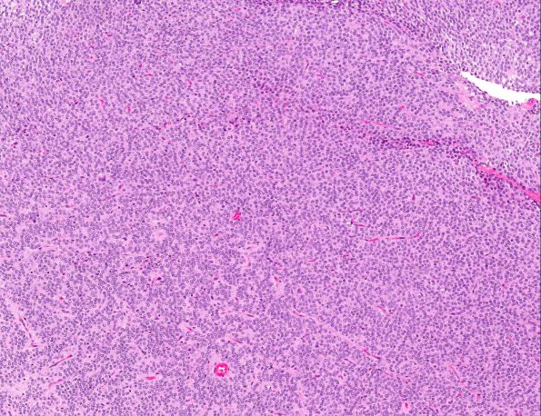 9A2 Neurocytoma, central (AANP 1999, Case 3) H&E X10 1