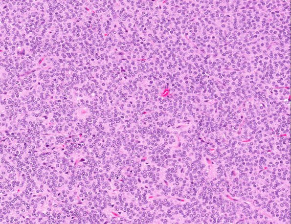 9A3 Neurocytoma, central (AANP 1999, Case 3) H&E X20 1