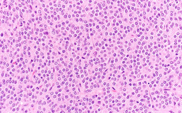 9A4 Neurocytoma, central (AANP 1999, Case 3) H&E 40X