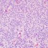 9A5 100A2 Neurocytoma, central (AANP1999-Case 3) H&E 3