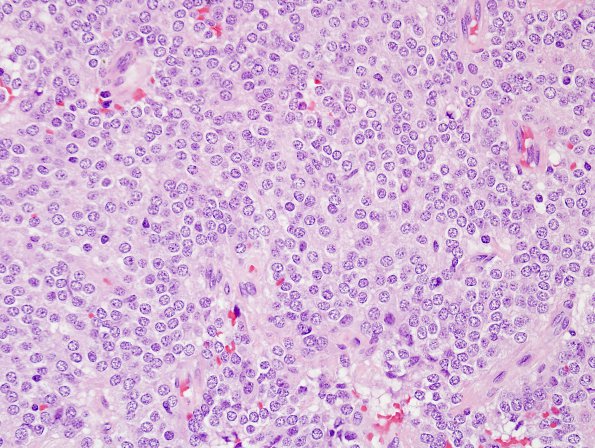 9A5 100A2 Neurocytoma, central (AANP1999-Case 3) H&E 3