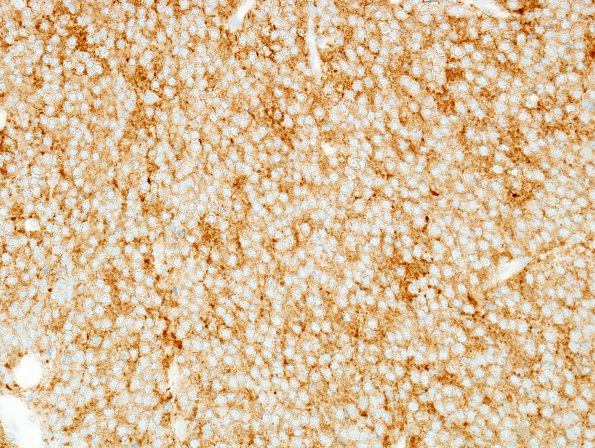 9B2 Neurocytoma, central (AANP1993-Case 3) SYN