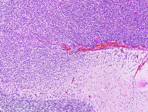 1A1 Liponeurocytoma, cerebellar (Case 1) H&E 8.jpg