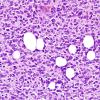 1A10 Liponeurocytoma, cerebellar (Case 1) H&E 22.jpg