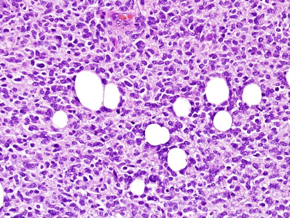 1A10 Liponeurocytoma, cerebellar (Case 1) H&E 22.jpg