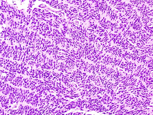 1A11 Liponeurocytoma, cerebellar (Case 1) H&E 49.jpg