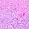 1A2 Liponeurocytoma, cerebellar (Case 1) H&E 3A.jpg