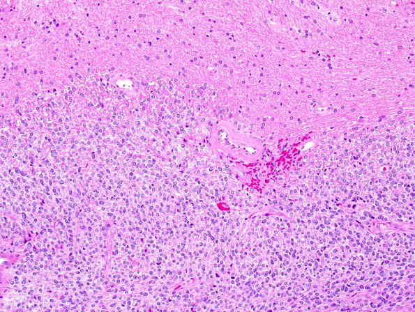 1A2 Liponeurocytoma, cerebellar (Case 1) H&E 3A.jpg