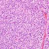 1A3 Liponeurocytoma, cerebellar (Case 1) 56