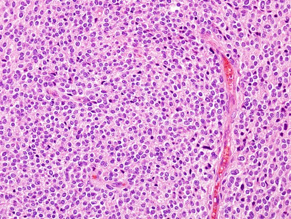 1A3 Liponeurocytoma, cerebellar (Case 1) 56