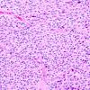 1A4 Liponeurocytoma, cerebellar (Case 1) 5.jpg