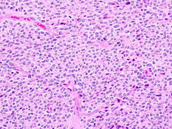 1A4 Liponeurocytoma, cerebellar (Case 1) 5.jpg