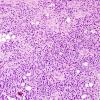 1A5 Liponeurocytoma, cerebellar (Case 1) H&E 10.jpg