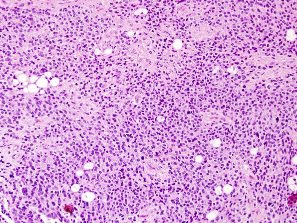 1A5 Liponeurocytoma, cerebellar (Case 1) H&E 10.jpg