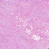 1A6 Liponeurocytoma, cerebellar (Case 1) 53