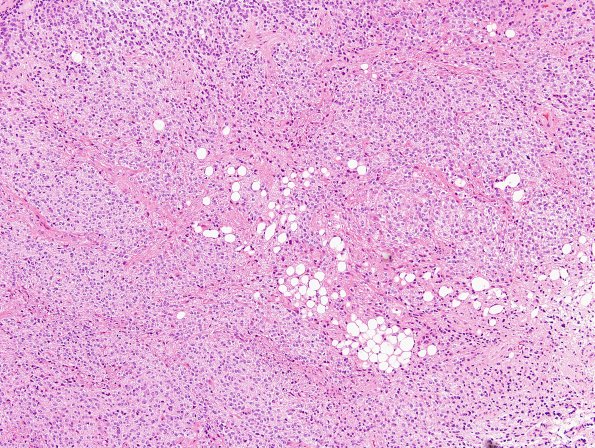 1A6 Liponeurocytoma, cerebellar (Case 1) 53