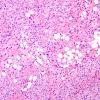 1A7 Liponeurocytoma, cerebellar (Case 1) 55