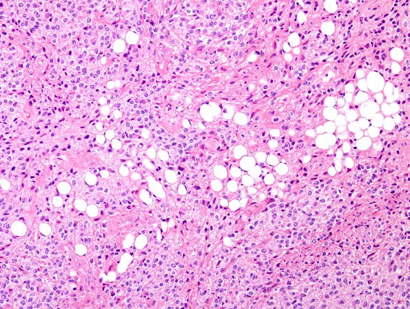 1A7 Liponeurocytoma, cerebellar (Case 1) 55