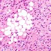 1A8 Liponeurocytoma, cerebellar (Case 1) 54